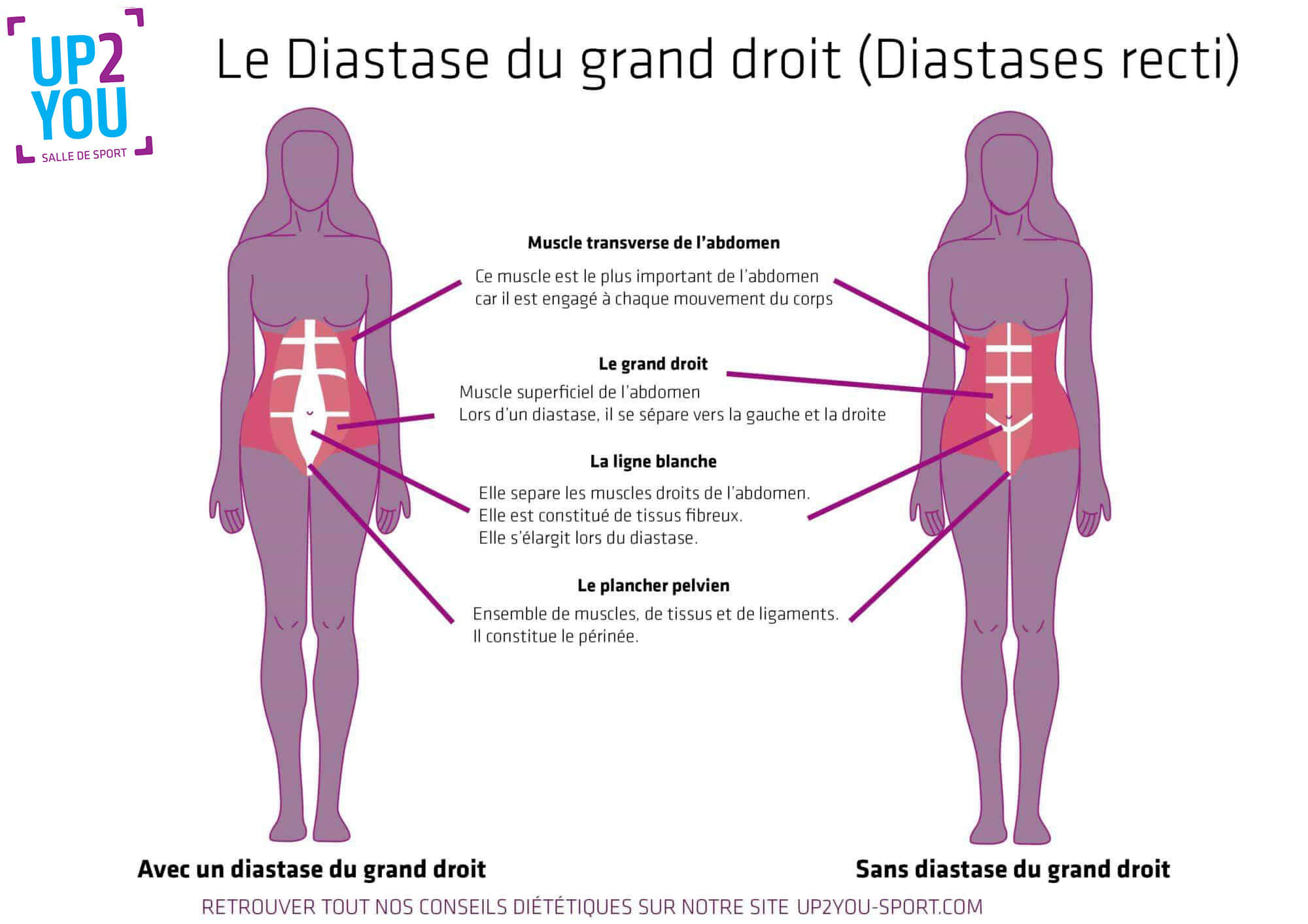 Diastases recti : le Diastase du grand droit : explications 