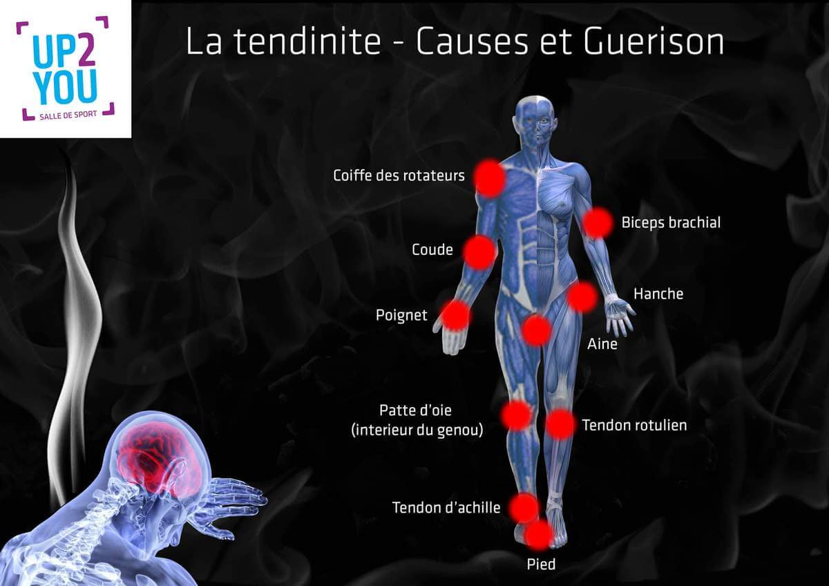 Tendinite - causes et guerison